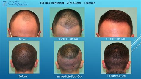 Follicular Unit Extraction (FUE) .